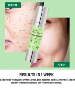 NEGUSY® USA DermaClear Reedle Shot 100 Wart & Mole Eraser Serum