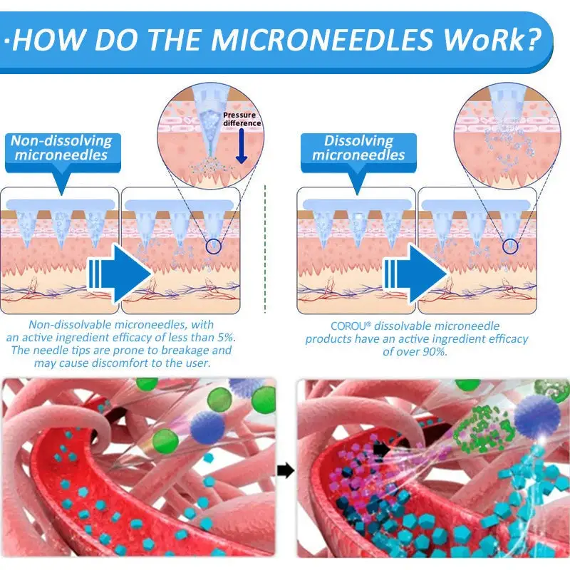 СΟRΟU® GLP-1 Nаnо Mісrоnееdlе Раtсh