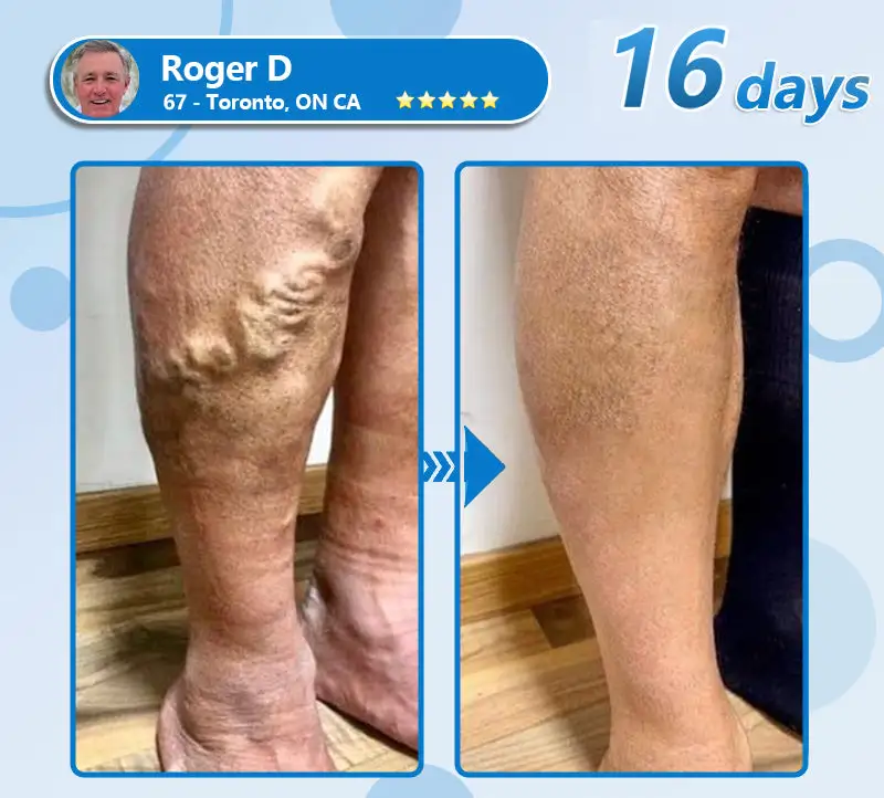 СΟRΟU® GLP-1 Nаnо Mісrоnееdlе Раtсh