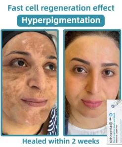 𝑲i𝒅sn𝒆𝒆𝒅® 𝑵on-i𝒏va𝒔𝒊ve 𝑴o𝒍e an𝒅 𝑾ar𝒕 𝑹emo𝒗𝒂𝒍 𝑳ase𝒓 𝑷en