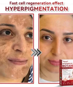 𝑉𝑠𝑜𝑥𝑎® 𝑀𝑖𝑐𝑟𝑜𝑛𝑒𝑒𝑑𝑙𝑒𝑠 𝐵𝑜𝑡𝑎𝑛𝑖𝑐 𝑆𝑘𝑖𝑛 𝑇𝑎𝑔𝑠 𝑆𝑜𝑙𝑢𝑡𝑖𝑜𝑛 𝑃𝑎𝑡𝑐ℎ𝑒𝑠