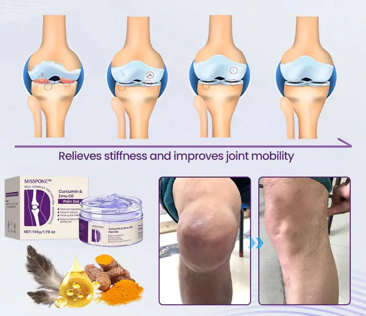Misspone™ Curcumin & Emu Oil Pain Gel