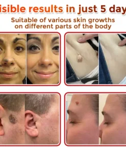 BotaniClear™ USA-Made MicroNeedle Patch for Skin Tags