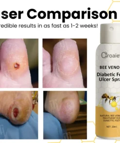 Croaie® Bee Venom Diabetic Foot Ulcer Spray