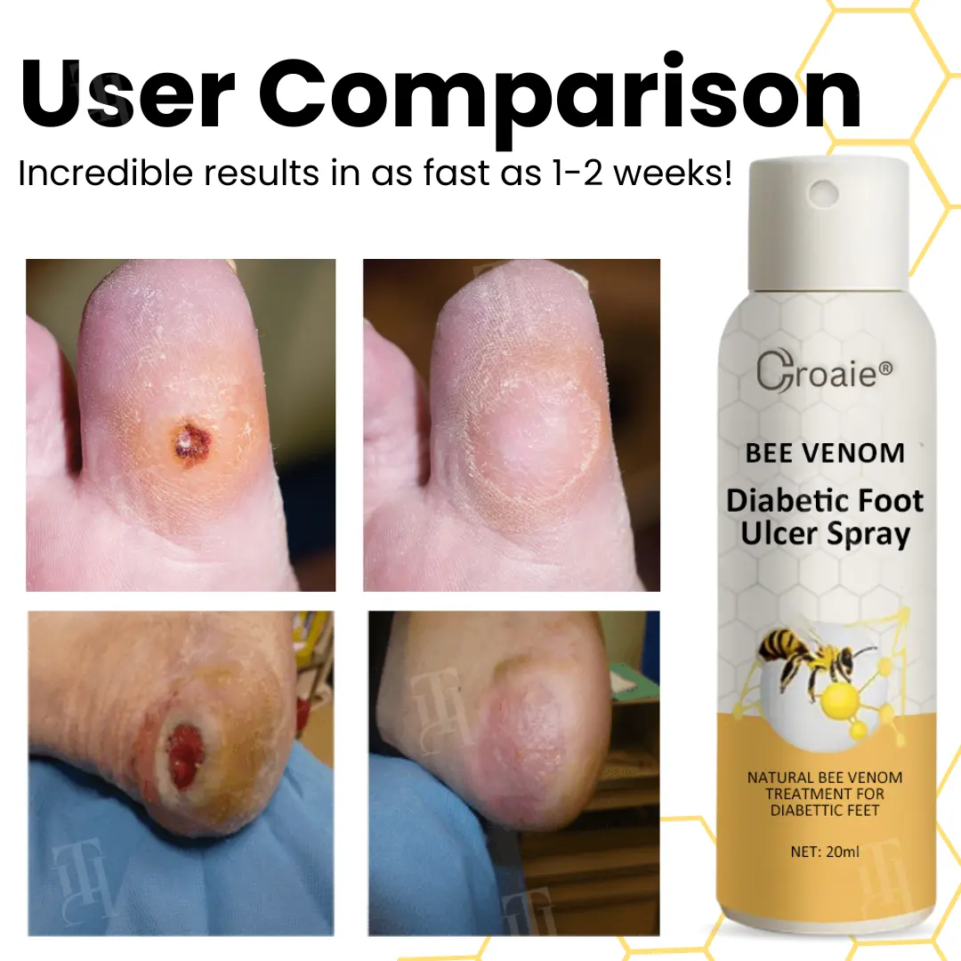 Croaie® Bee Venom Diabetic Foot Ulcer Spray