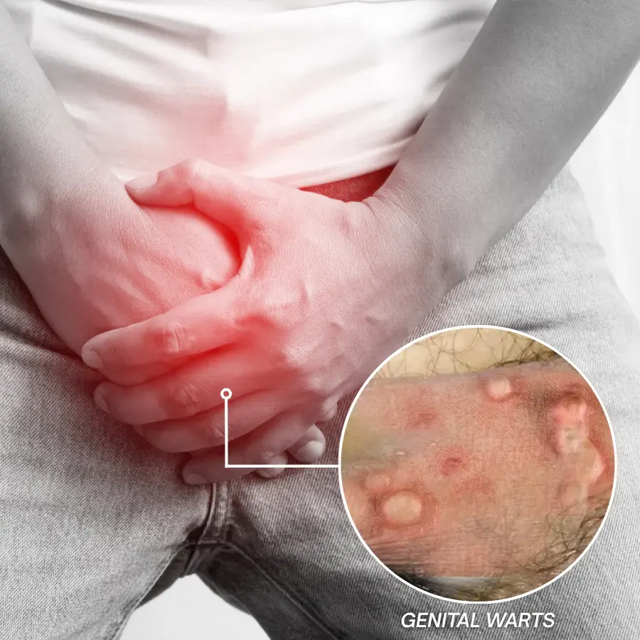 Femica® GentX WartRelief Cream