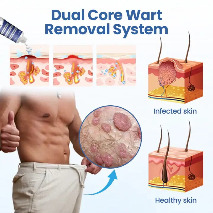 Femica® GentX WartRelief Cream