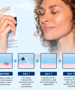 Femica® TagRecede Cryo Treatment Spray