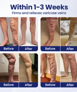 Furzero® VeinFreedom Herbal Spray