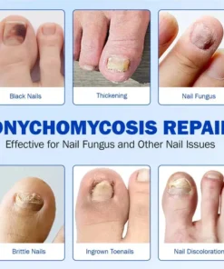 Juxek™ Pro Nail Repair Pen – 25% Undecylenic Acid