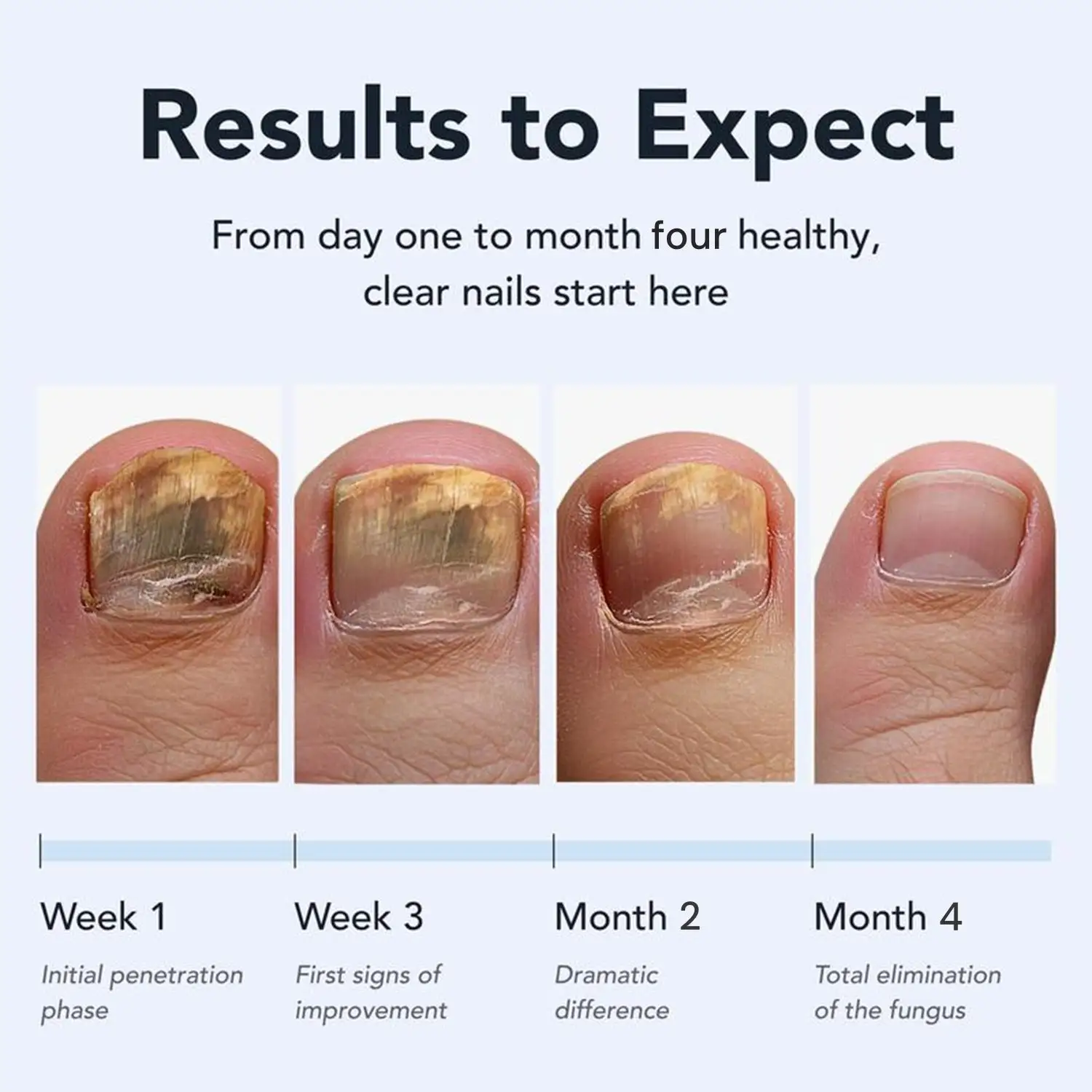 Juxek™ Pro Nail Repair Pen – 25% Undecylenic Acid