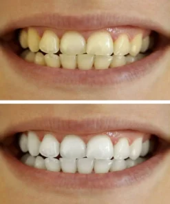 Misspone® Essential Care Toothpaste – 6 - in - 1 Whitening + Total Care