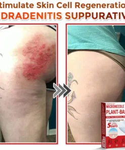 Newyuo® MicroNeedle Botanic Skin Tag Removal Patch