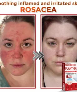 Newyuo® MicroNeedle Botanic Skin Tag Removal Patch