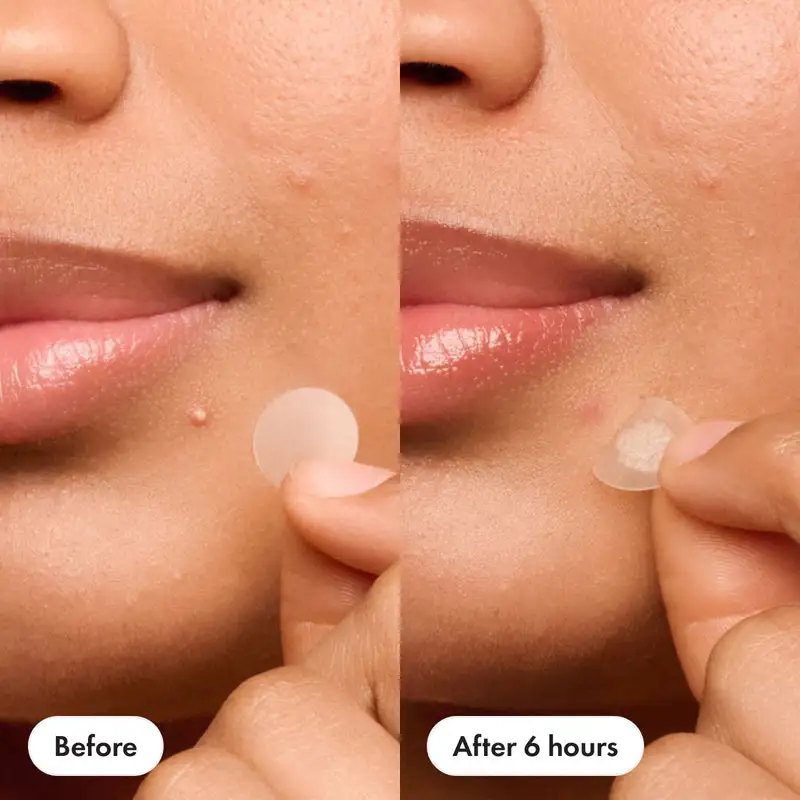 Nexisify™ – Pimple Patch for Clear Skin Overnight (36 Pcs)