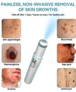 𝐍𝐨𝐧-𝐈𝐧𝐯𝐚𝐬𝐢𝐯𝐞 𝐌𝐨𝐥𝐞 & 𝐖𝐚𝐫𝐭 𝐋𝐚𝐬𝐞𝐫 𝐑𝐞𝐦𝐨𝐯𝐚𝐥 𝐏𝐞𝐧