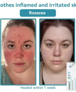 𝐍𝐨𝐧-𝐈𝐧𝐯𝐚𝐬𝐢𝐯𝐞 𝐌𝐨𝐥𝐞 & 𝐖𝐚𝐫𝐭 𝐋𝐚𝐬𝐞𝐫 𝐑𝐞𝐦𝐨𝐯𝐚𝐥 𝐏𝐞𝐧