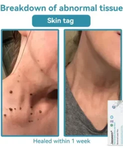 𝐍𝐨𝐧-𝐈𝐧𝐯𝐚𝐬𝐢𝐯𝐞 𝐌𝐨𝐥𝐞 & 𝐖𝐚𝐫𝐭 𝐋𝐚𝐬𝐞𝐫 𝐑𝐞𝐦𝐨𝐯𝐚𝐥 𝐏𝐞𝐧