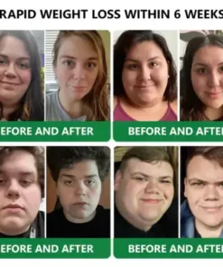 𝑵𝒂𝒏𝒐 𝑴𝒊𝒄𝒓𝒐𝒏𝒆𝒆𝒅𝒍𝒆 𝑷𝒂𝒕𝒄𝒉 𝒘𝒊𝒕𝒉 𝑺𝑴𝑮𝑻-𝑮𝑳𝑷-1 & 𝑴𝒂𝒕𝒓𝒊𝒙𝒚𝒍 3000