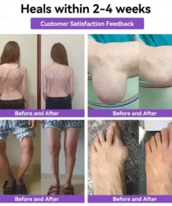 𝑀𝑒𝑔𝑙𝑢𝑡𝑖𝑑𝑒 & 𝐵𝑜𝑡𝑜𝑥 𝑁𝑎𝑛𝑜-𝑚𝑖𝑐𝑟𝑜𝑛𝑒𝑒𝑑𝑙𝑒 𝐽𝑜𝑖𝑛𝑡 𝑃𝑎𝑡𝑐ℎ