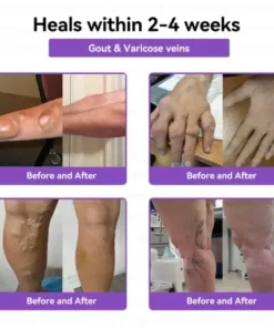 𝑀𝑒𝑔𝑙𝑢𝑡𝑖𝑑𝑒 & 𝐵𝑜𝑡𝑜𝑥 𝑁𝑎𝑛𝑜-𝑚𝑖𝑐𝑟𝑜𝑛𝑒𝑒𝑑𝑙𝑒 𝐽𝑜𝑖𝑛𝑡 𝑃𝑎𝑡𝑐ℎ