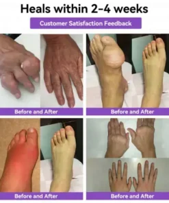 𝑀𝑒𝑔𝑙𝑢𝑡𝑖𝑑𝑒 & 𝐵𝑜𝑡𝑜𝑥 𝑁𝑎𝑛𝑜-𝑚𝑖𝑐𝑟𝑜𝑛𝑒𝑒𝑑𝑙𝑒 𝐽𝑜𝑖𝑛𝑡 𝑃𝑎𝑡𝑐ℎ