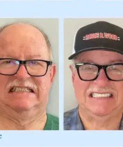 Advanced Customized Full Denture Set