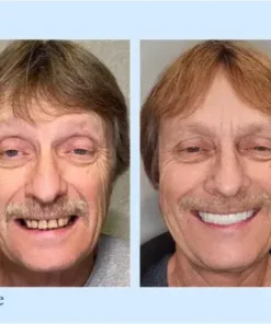 Advanced Customized Full Denture Set