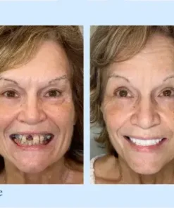 Advanced Customized Full Denture Set