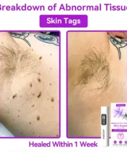 Advanced Non-Invasive Skin Repair CO₂ Laser Pen