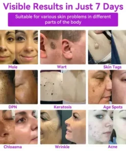 Advanced Non-Invasive Skin Repair CO₂ Laser Pen