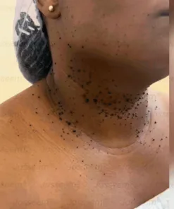 Advanced Non-Invasive Skin Repair CO₂ Laser Pen