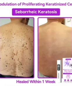 Advanced Non-Invasive Skin Repair CO₂ Laser Pen