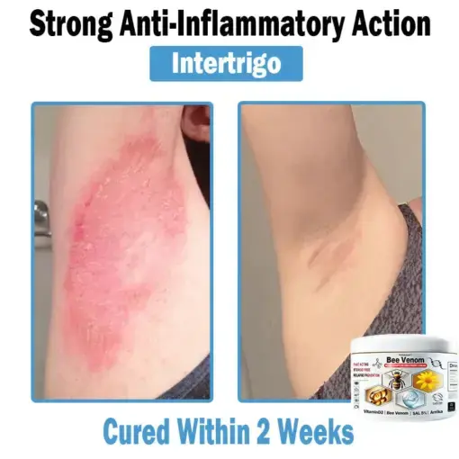 Bee Venom Multi-Symptom Skin Treatment Cream