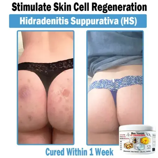 Bee Venom Multi-Symptom Skin Treatment Cream