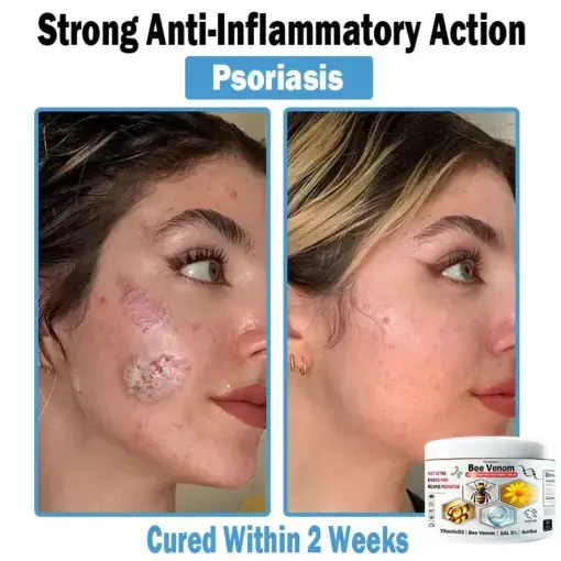 Bee Venom Multi-Symptom Skin Treatment Cream