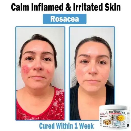 Bee Venom Multi-Symptom Skin Treatment Cream