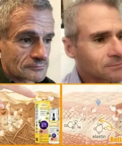 Bee Venom Senile Purpura Cream