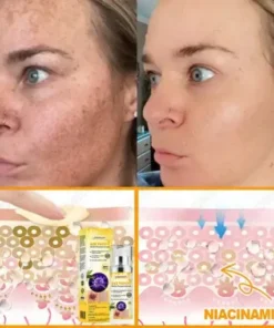 Bee Venom Senile Purpura Cream