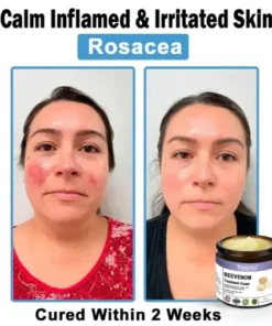 Bee Venom Skin Treatment Cream