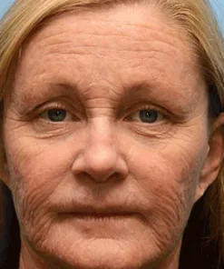 Instant skin tightening Cream