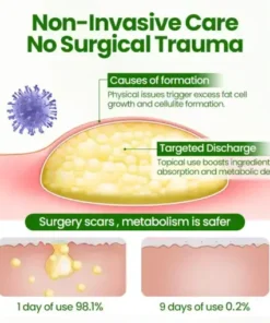 KnotAway Lipoma Removal Cream