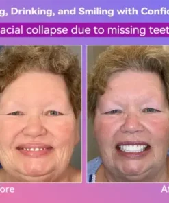 Latest Premium Comfort Dentures