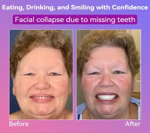 Latest Premium Comfort Dentures