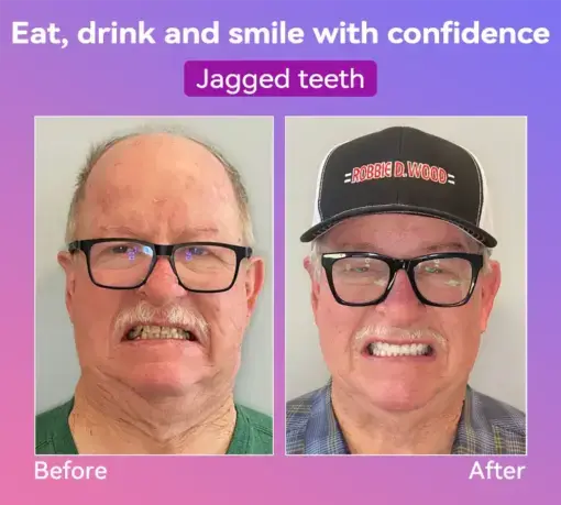Latest Premium Comfort Dentures