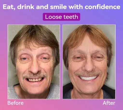Latest Premium Comfort Dentures