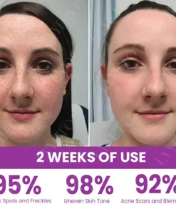 MelantraX Advanced Brightening Essence ACE