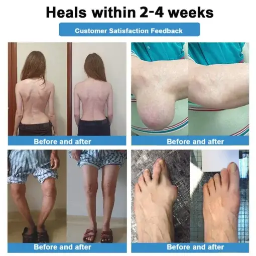 Nano-Microneedle Joint Patch