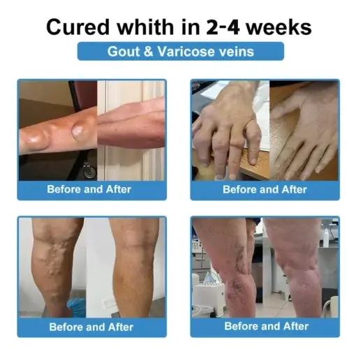 Nano-Microneedle Joint Patch