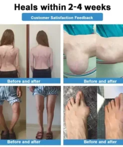 Nano-microneedle joint patch